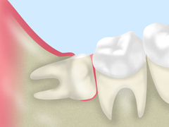 あなたの歯の痛み……もしかしたら親知らずが原因かも？